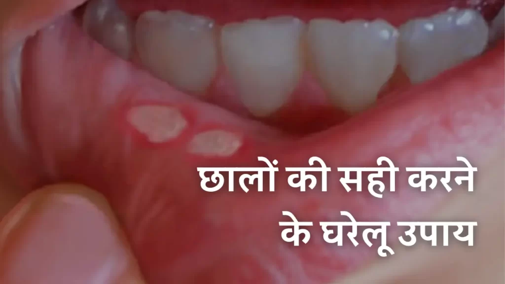 छालों की सही करने के घरेलू उपाय